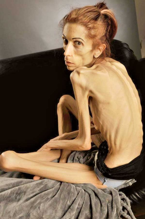 Trucos para adelgazar anorexia recovery