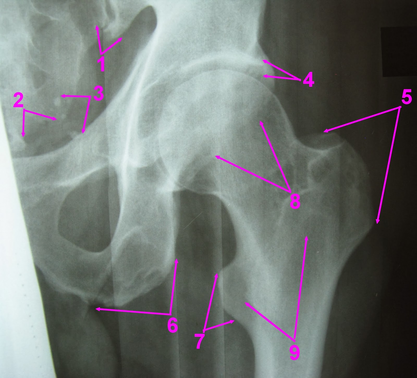 рентген коксартроза тазобедренного сустава 2 степени. коксартроз 3 степени рентген описание. коксартроз тазобедренного сустава рентген. суставная щель тазобедренного сустава. 4мм суставная щель тазобедренного сустава.