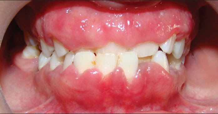 20+ Natural Home Remedies for Swollen Gums