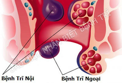 Cách phòng bệnh trĩ không tái phát Cách phòng bệnh trĩ không tái phát