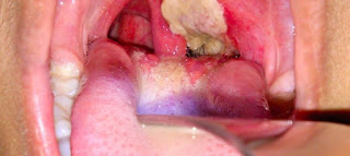 Wabak Difteria - 13 kes 5 maut Wabak Difteria - 13 kes 5 maut