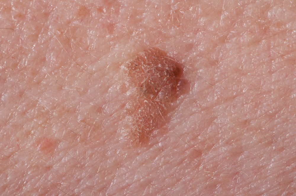 Discolored Skin Patches : 38 Causes, Photos & Treatments