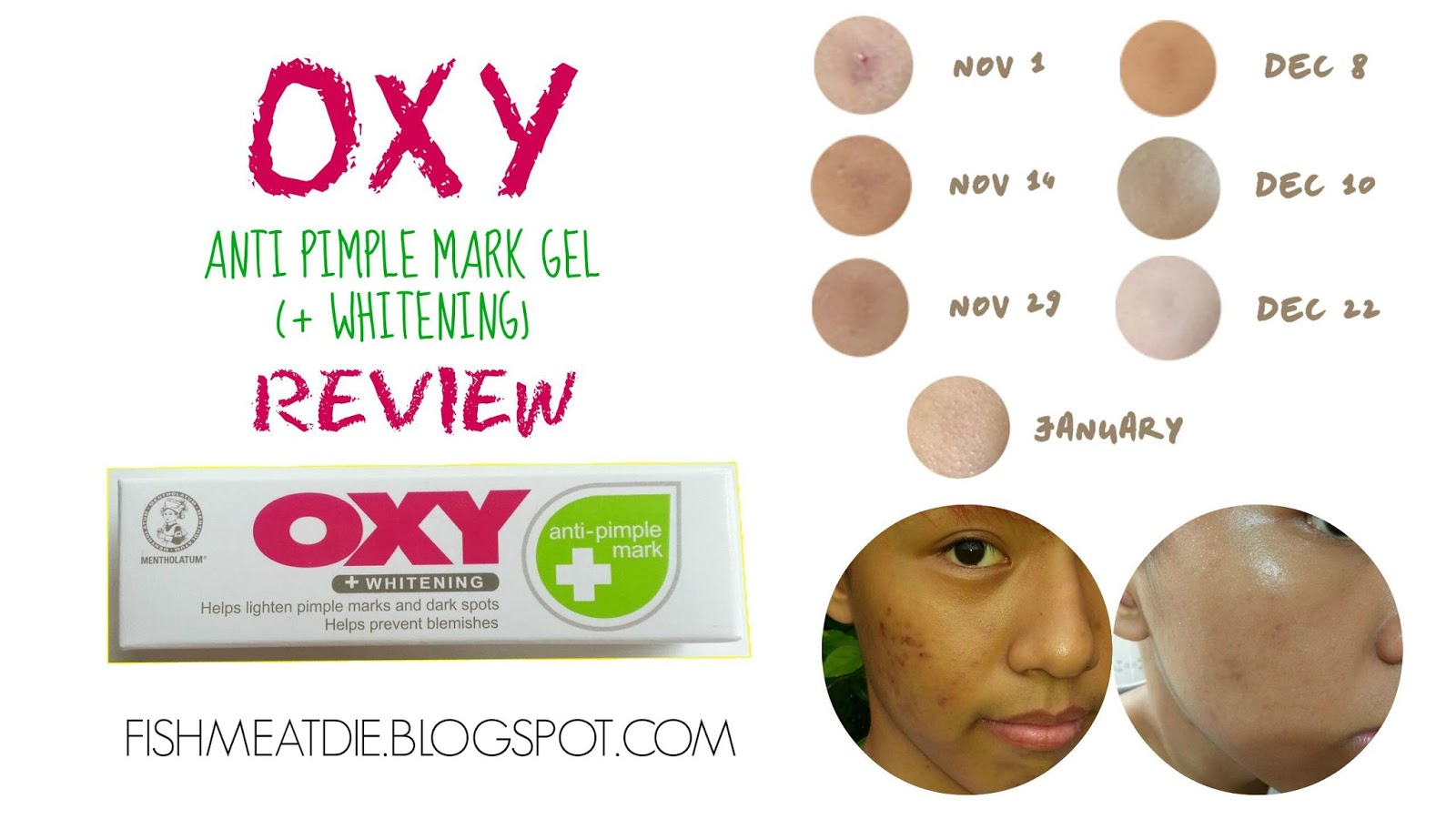 OXY Anti Pimple Mark Gel (+ Whitening) Review | FISHMEATDIE