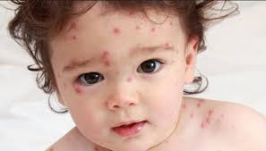OBAT ALERGI PADA ANAK TIMBUL BINTIK KECIL TERASA GATAL OBAT ALERGI PADA ANAK TIMBUL BINTIK KECIL TERASA GATAL