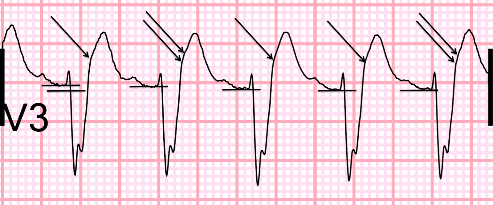 Dr. Smith's ECG Blog December 2015