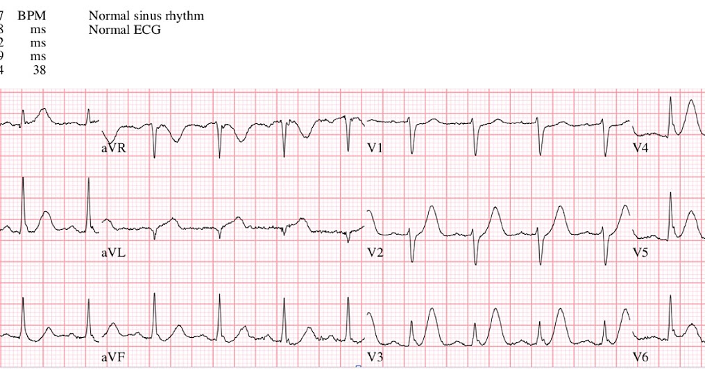расслаивающаяся аневризма аорты дифференциальный диагноз. изменения на экг при аневризме левого желудочка. электрокардиографический признак аневризмы сердца:. экг при кардиогенном шоке. аневризма аорты на экг.