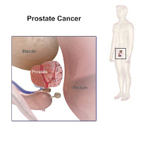 Definisi Kanker Prostat