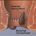Pengobatan obat tradisional wasir eksternal thumbnail