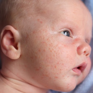 How Long Does Baby Acne Last 