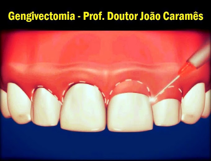 SORRISO GENGIVAL: Gengivectomia - Prof. Doutor João Caramês