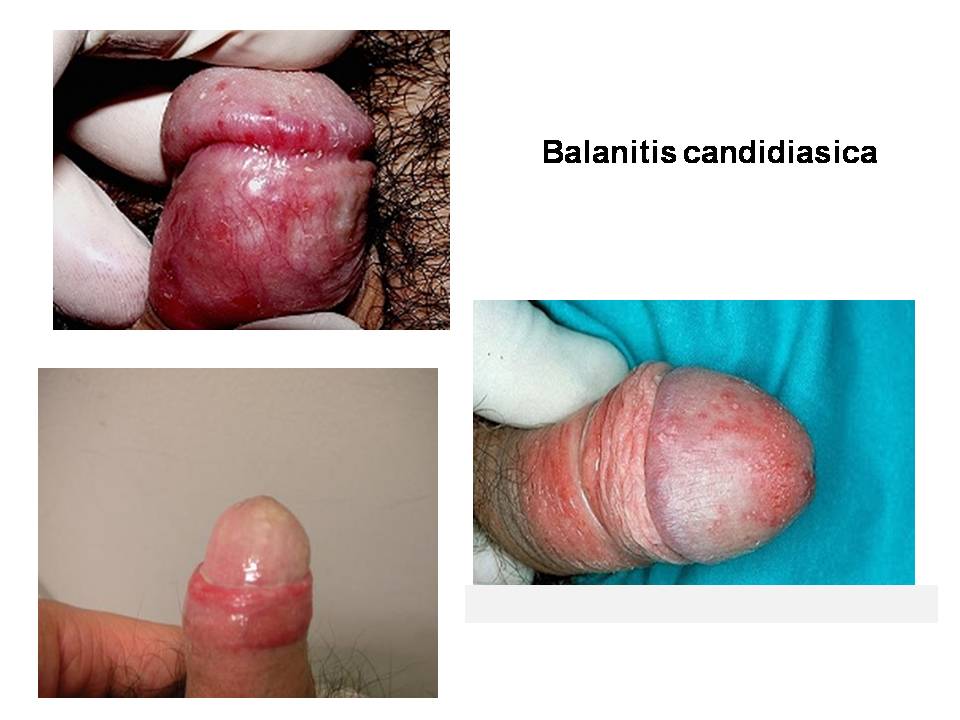 Balanitis que significa