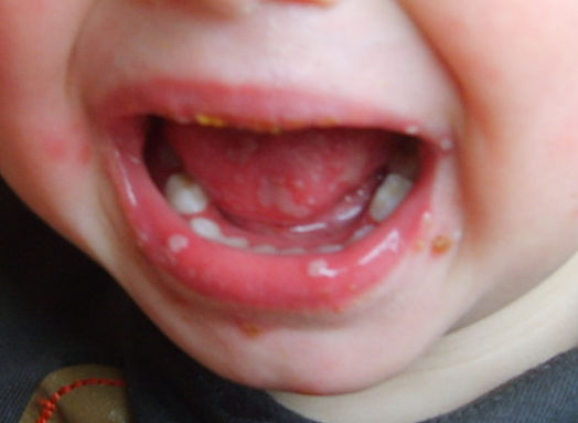 mond hand voet ziekte - DrBeckmann