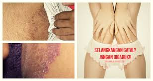 Obat Eksim Pada Selangkangan Dan Pantat Obat Eksim Pada Selangkangan Dan Pantat