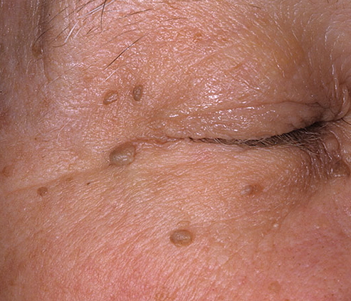 Anal Skin Tag Picture 106