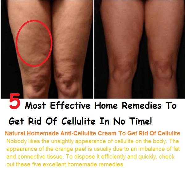 Home Remedies To Get Rid Of Cellulite, Getting Rid Of Cellulite, How To Get Rid Of Cellulite, Remove Cellulite, Cellulite Treatment, What Is Cellulite, Thigh Cellulite
