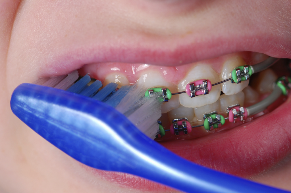 Braces Pain Relief How to Brush Teeth with Braces?