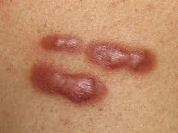 HERBAL/NATURAL/HOME REMEDY FOR TREATING KELOIDS HERBAL/NATURAL/HOME REMEDY FOR TREATING KELOIDS