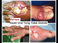 Cara Menyembuhkan Asam Urat Yang Sudah Parah Langsung Sembuh Cara Menyembuhkan Asam Urat Yang Sudah Parah Langsung Sembuh