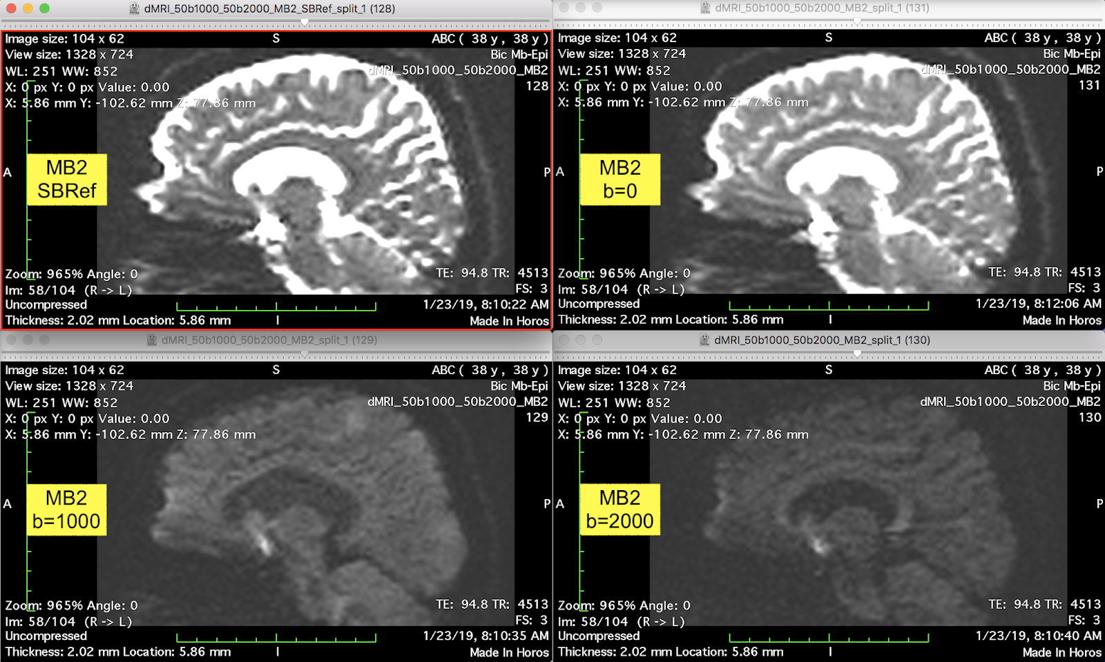 practiCal fMRI: the nuts & bolts: Using multiband-EPI for diffusion ...