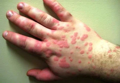 Penderita Alergi