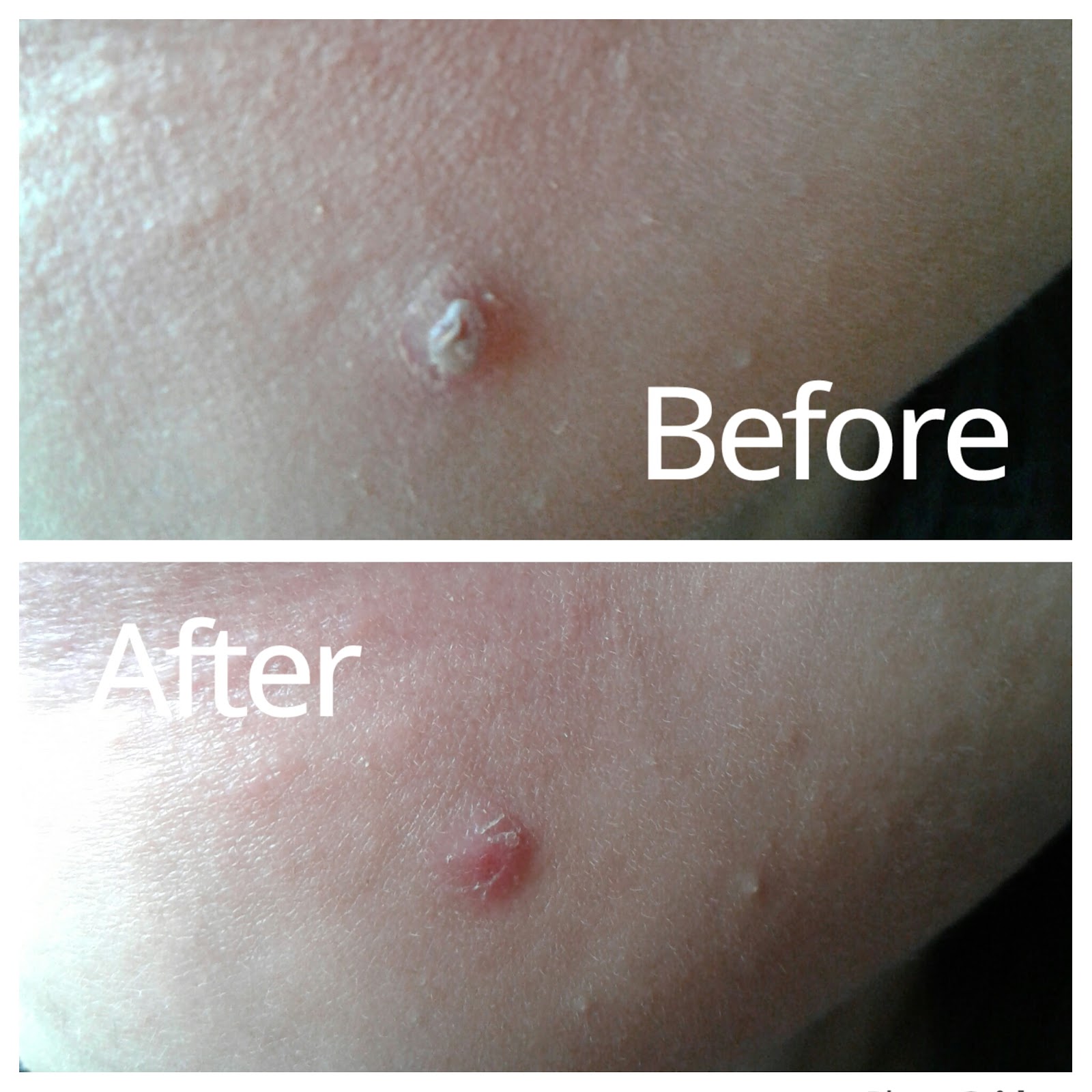 Firstaid Pimple Fix poshmakeupnstuff