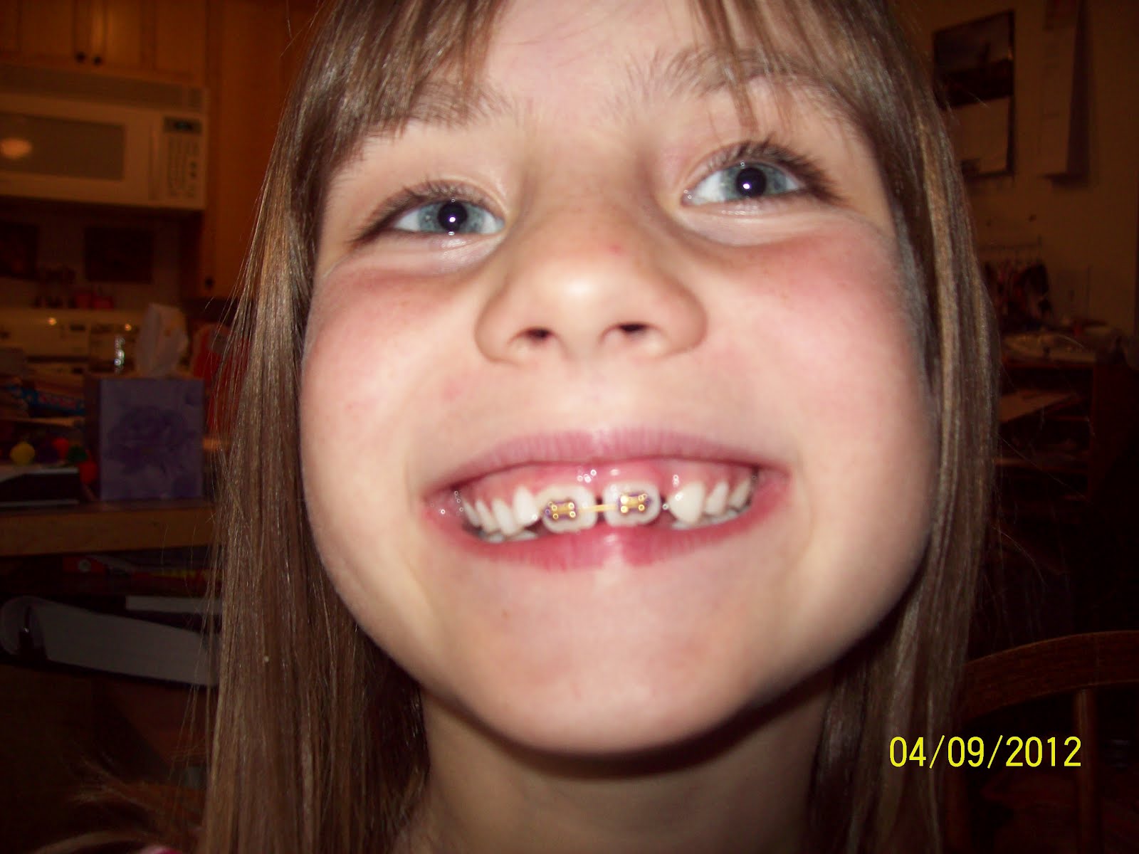 Loves of my life Braces?