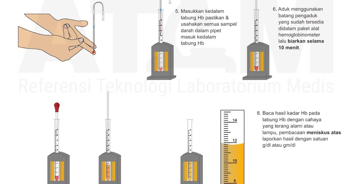 Pemeriksaan Hemoglobin (Hb) Metode Sahli's — ATLM