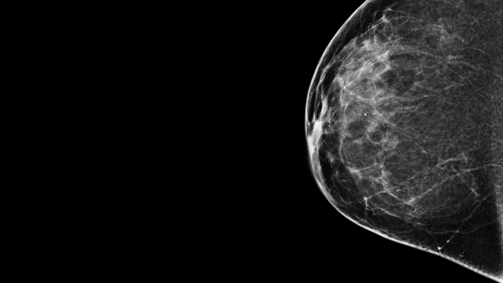 Towards Better Health Mammograms More Likely To Cause Unneeded towards-better-health-mammograms-more-likely-to-cause-unneeded