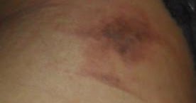 cicalfate avis dermatologue cicalfate avis dermatologue