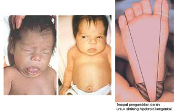 hipotiroid kongenital pada anak