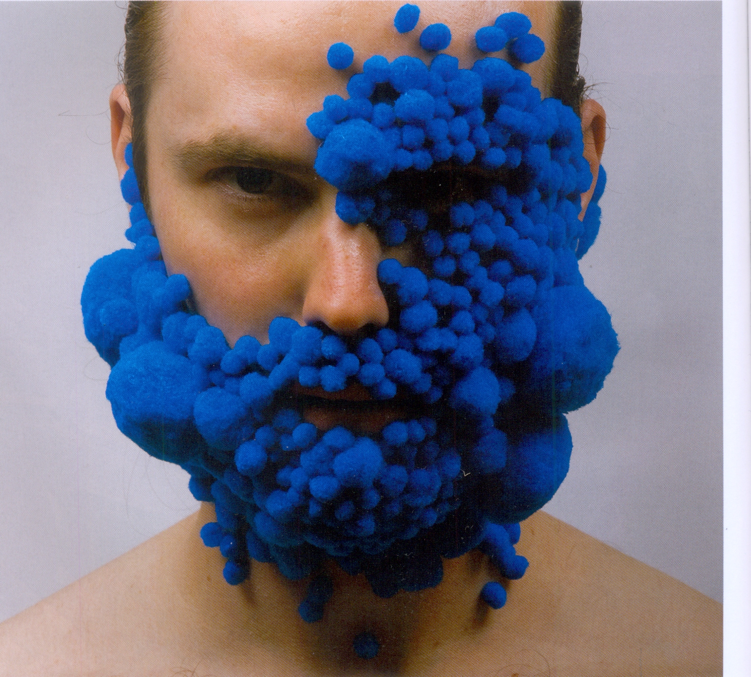 Генетические заболевания передающиеся по наследству синдромы. Синяя болезнь это. Аргироз пол карасон. Синяя болезнь это. Генетические заболевания передающиеся по наследству.