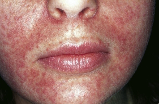 شخص مسؤول تسيطر الحمار علاج الوردية بالاعشاب الطبيعية caringforcarersindacorum com