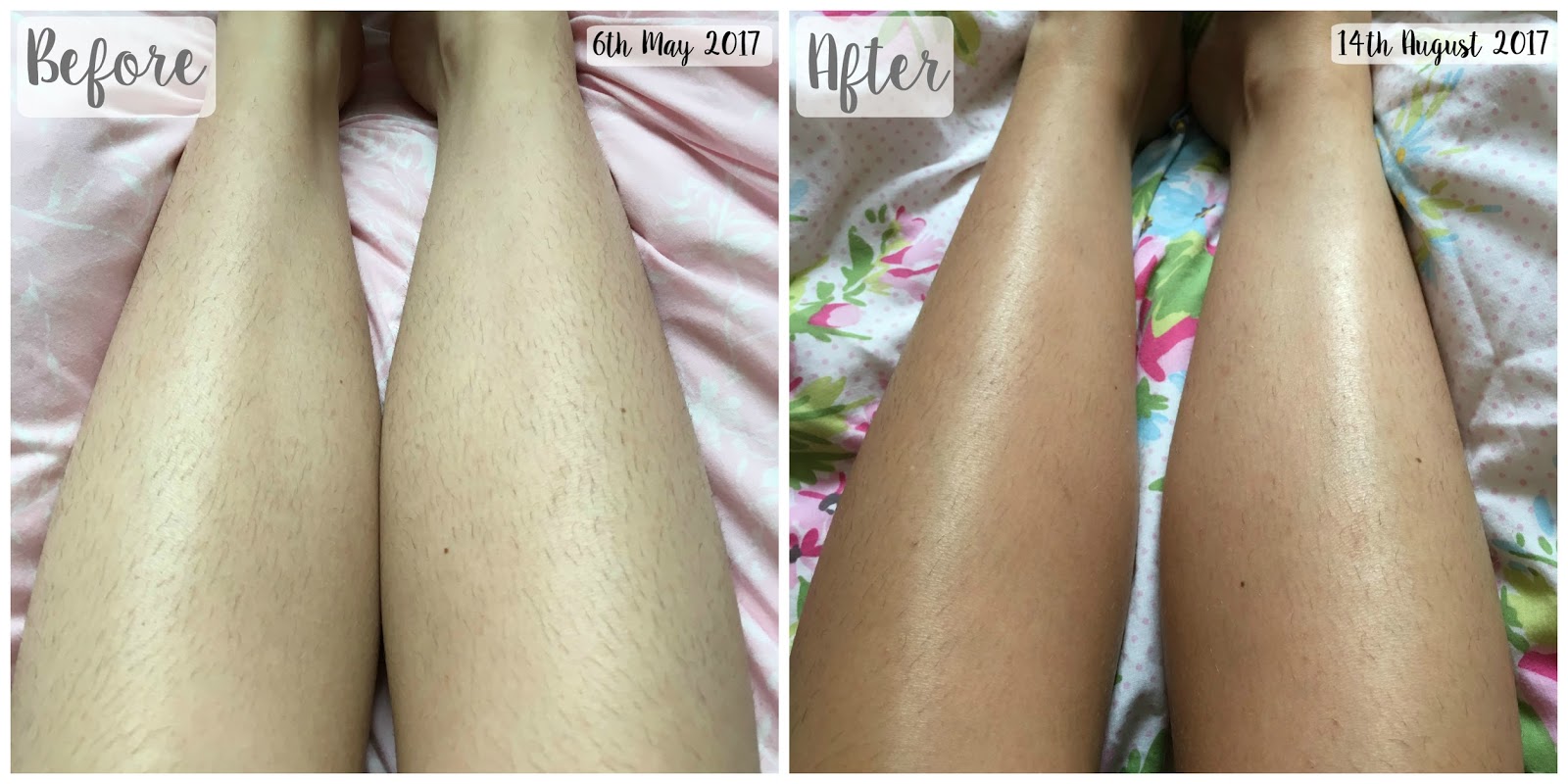 Tria Hair Removal Laser 4X | G Beauty