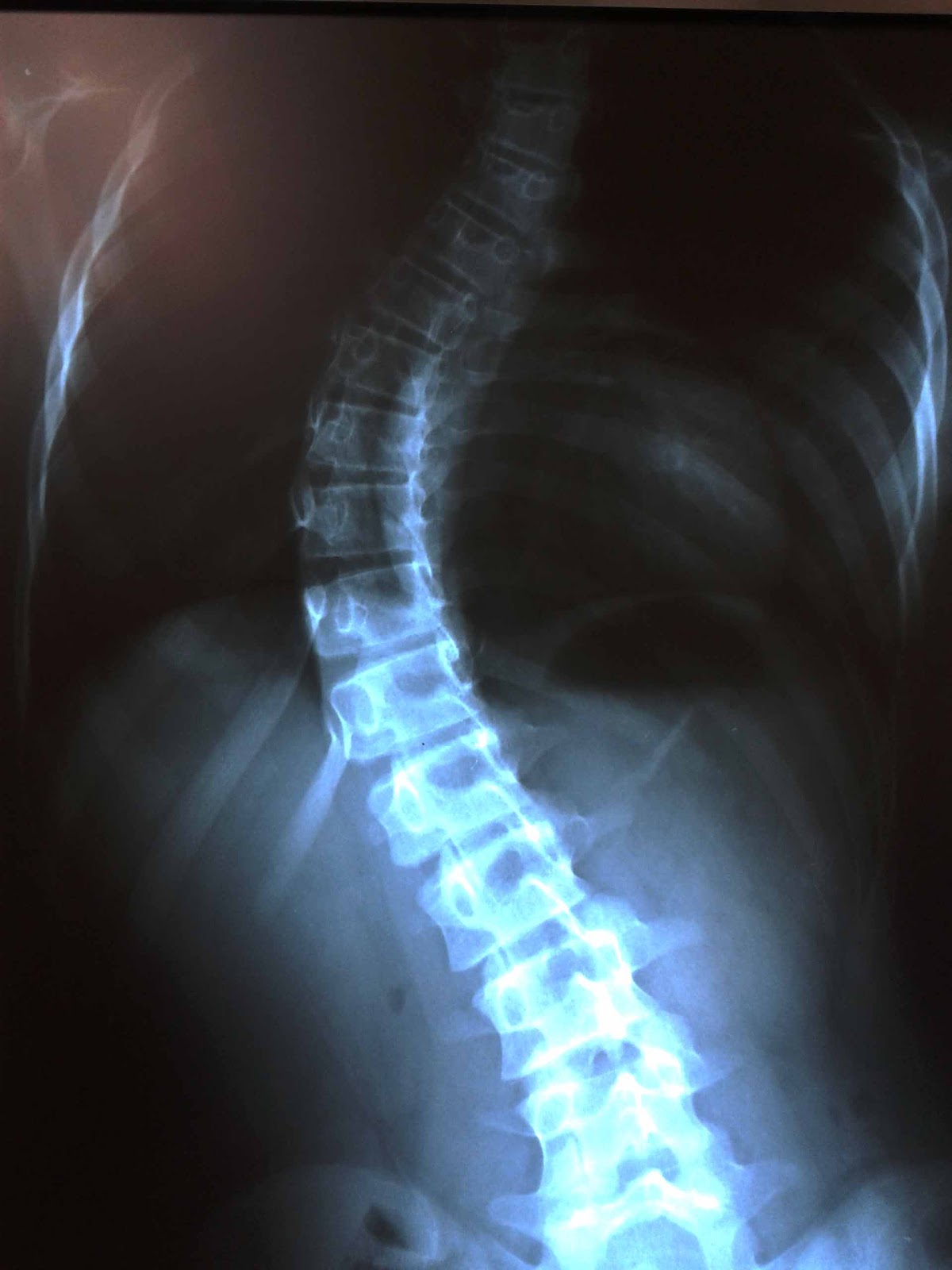 diabetes mellitus descompensada tratamiento escoliosis
