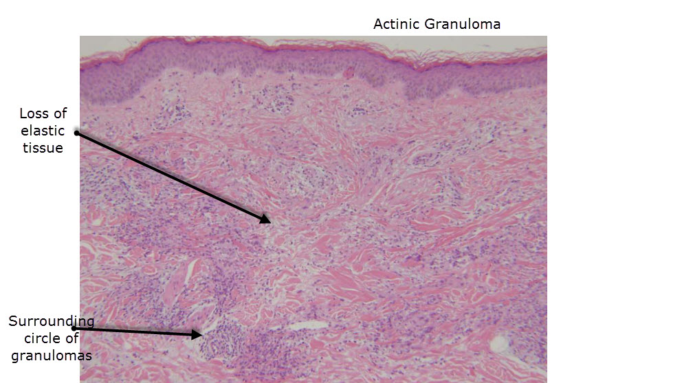 O'Brien’s Actinic Granuloma: an unusually extensive ...