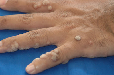 Οι μυρμηγκιές κολλάνε; Τι σχέση έχουν με το ΗPV, ποιοι κινδυνεύουν και πώς αντιμετωπίζονται; (φωτο) Warts-on-hands