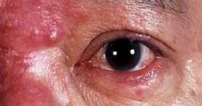 luz pulsada intensa rosacea antes y despues