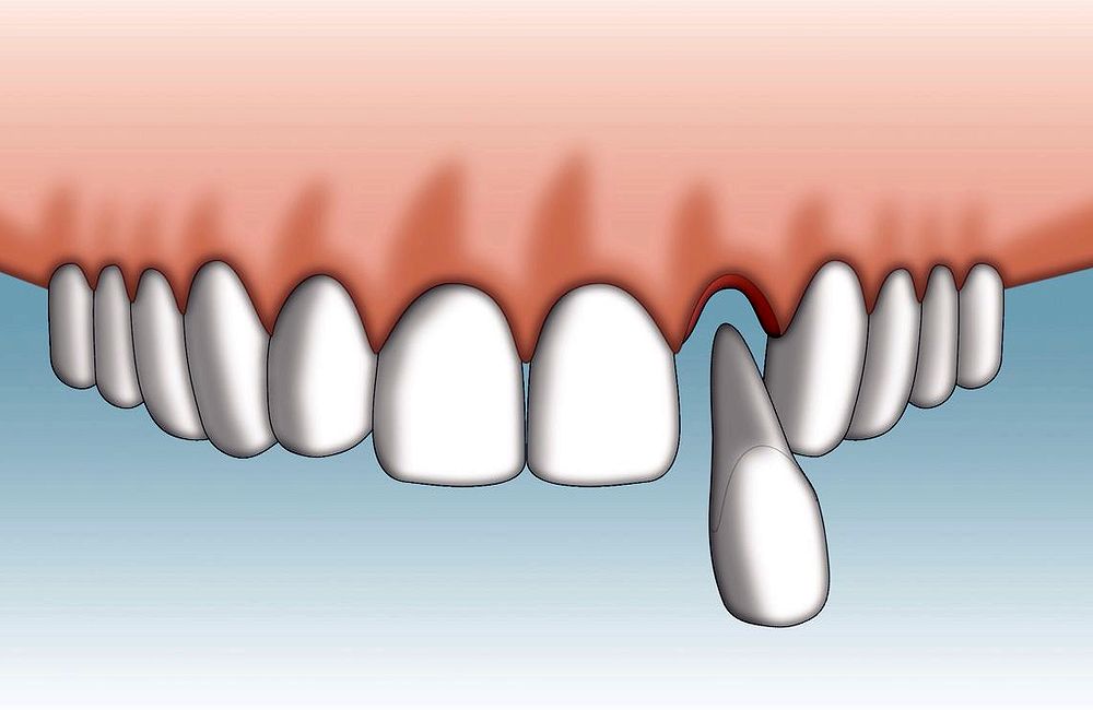 AVULSIÓN DENTAL Cómo reimplantar un diente caído Directorio Odontológico