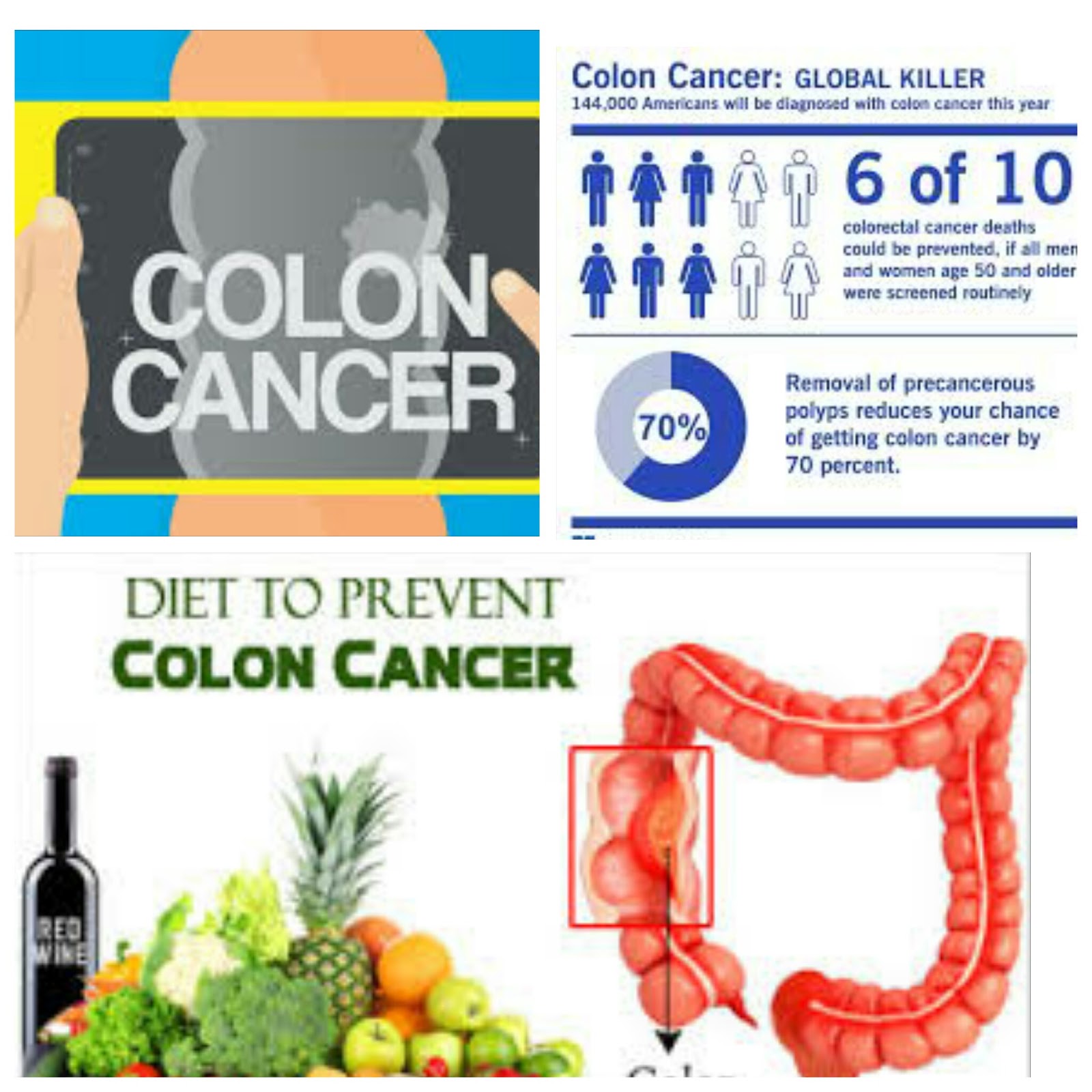 health with diet and sexual health: Diet to Prevent Colon Cancer