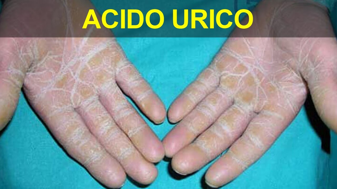 SyM Clínica Ocupacional y Asistencial S.A.C Dieta para el ácido úrico