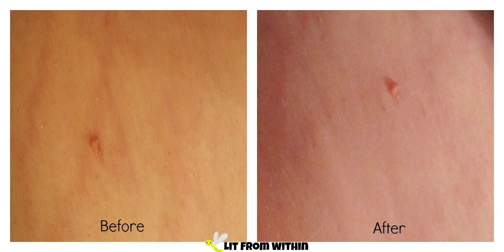 my stretch marks before and after using Body Merry's Stretch Marks & Scars Defense Cream 