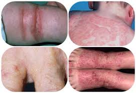 Salep Obat Herbal Untuk Penyakit Kulit Karena Eksim Kering salep obat herbal untuk penyakit kulit karena eksim kering