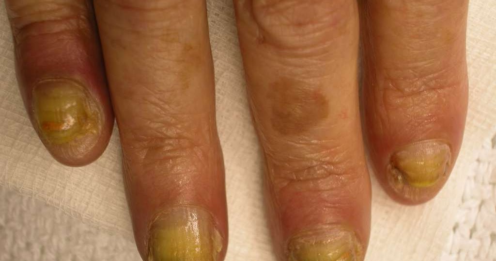 What causes finger nails to split Awesome Nail