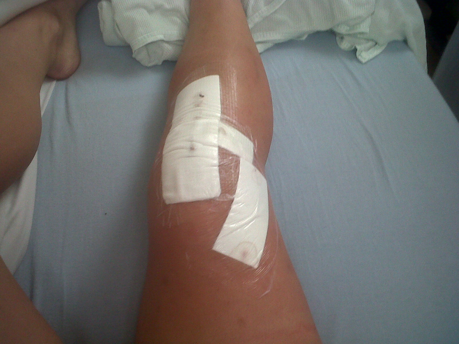 Female ACL Reconstruction