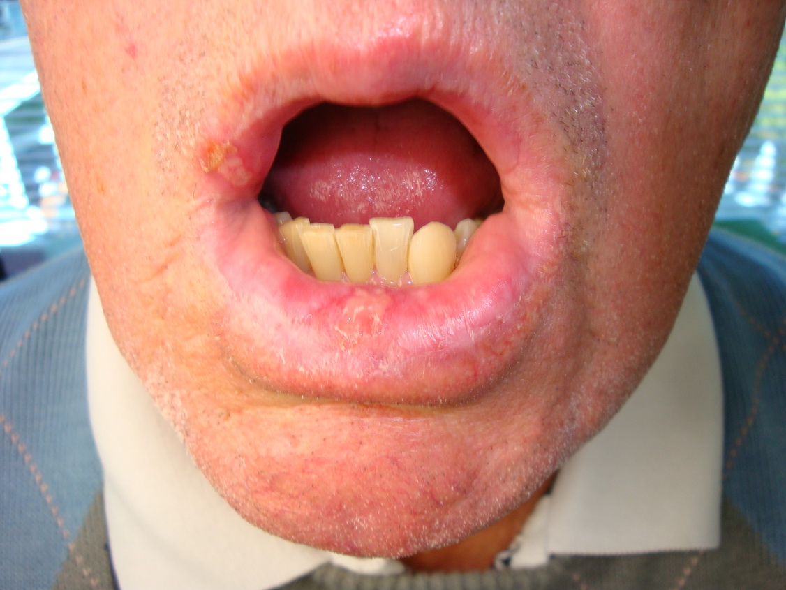 Leukoplakie: aandoening van het slijmvlies in de mond ...
