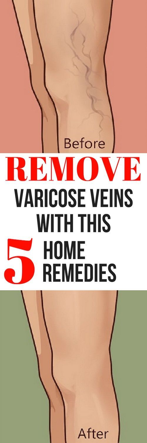 REMOVE VARICOSE VEINS IN YOUR LEGS WITH THIS 5 HOME REMEDIES HEALTH