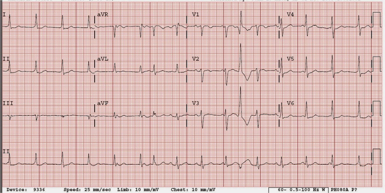 Dr. Smith's ECG Blog AV Dissociation. Is there AV block?