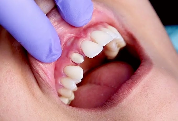 PROSTHODONTICS: Single-Unit Crown Workflow Solutions™ Procedure - Anterior Restoration