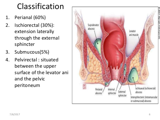 Urbanization what is anal abscess those on! What is anal abscess