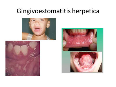 Gingivoestomatitis herpetica